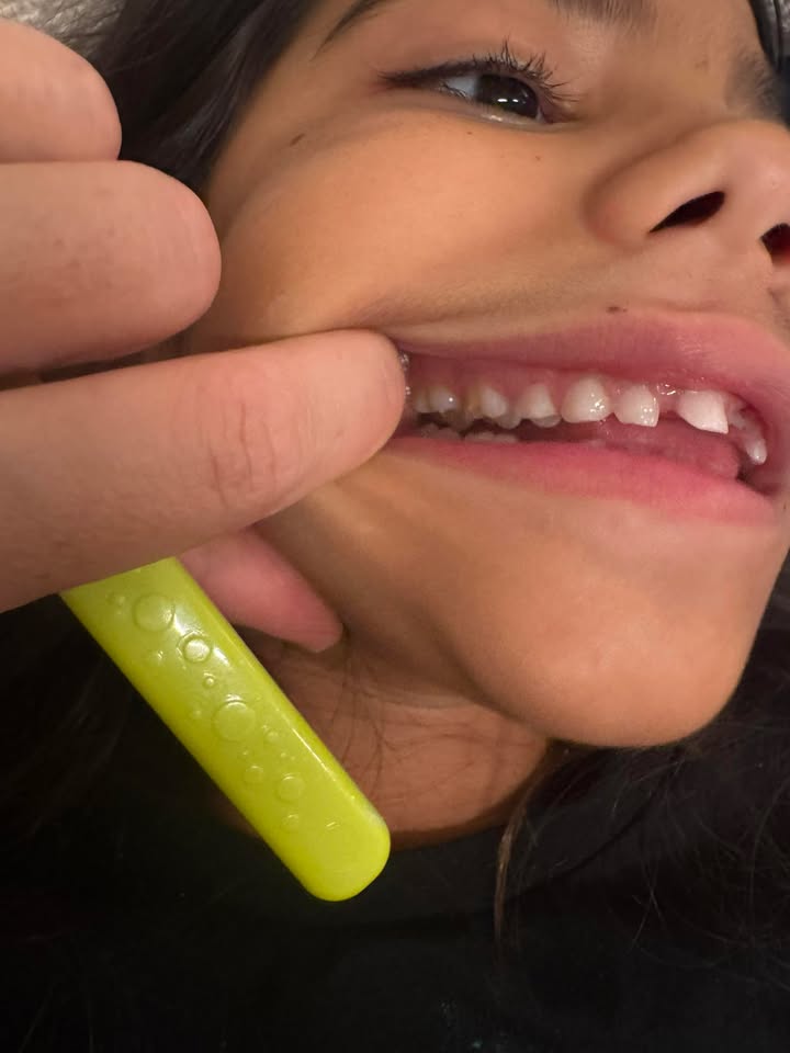 חסר שיניים מולד (Hypodontia)