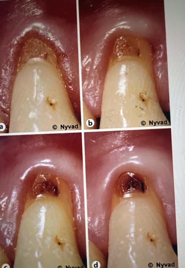 עששת בין השיניים (Proximal Caries)