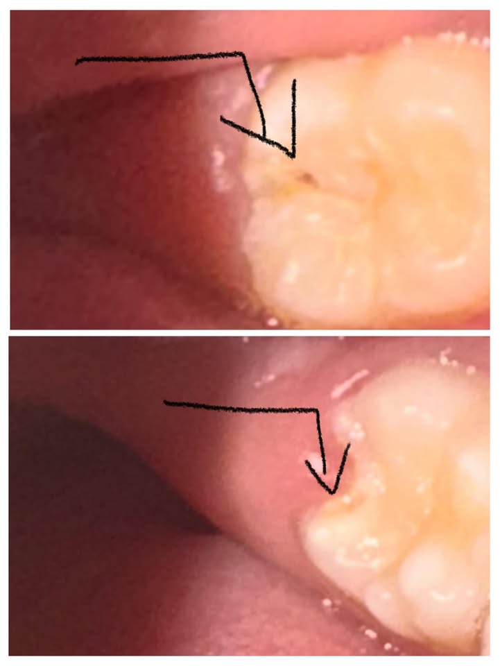 השן השישית: Money Tooth